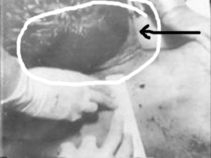 jfk autopsy photos kennedy assassination fake head wound