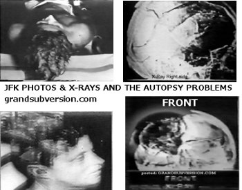 jfk autopsy photo head shot wound x rays john f  kennedy assassination picture pic