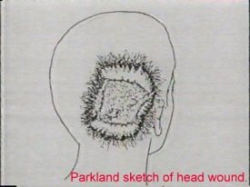 jfk parkland hospital head wound drawing 01