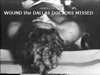 autopsy photo head injury wound brain jfk assassination pictures images