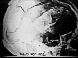 jfk assassination x ray photo kennedy autopsy