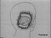 jfk autopsy parkland drawing head shot wound conspiracy 01
